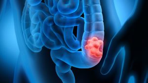 Colon (GI) Malignancies